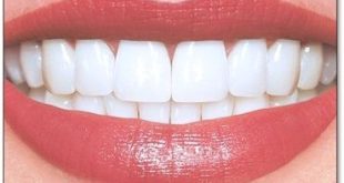 Teeth Whitening Tactics